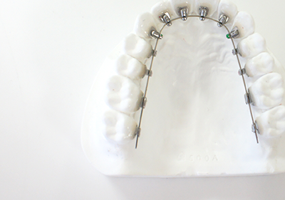 吉祥寺駅 北口・吉祥寺エル矯正歯科・矯正装置装着