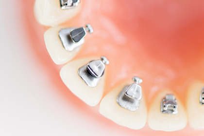 吉祥寺駅 北口・吉祥寺エル矯正歯科・裏側矯正の装置